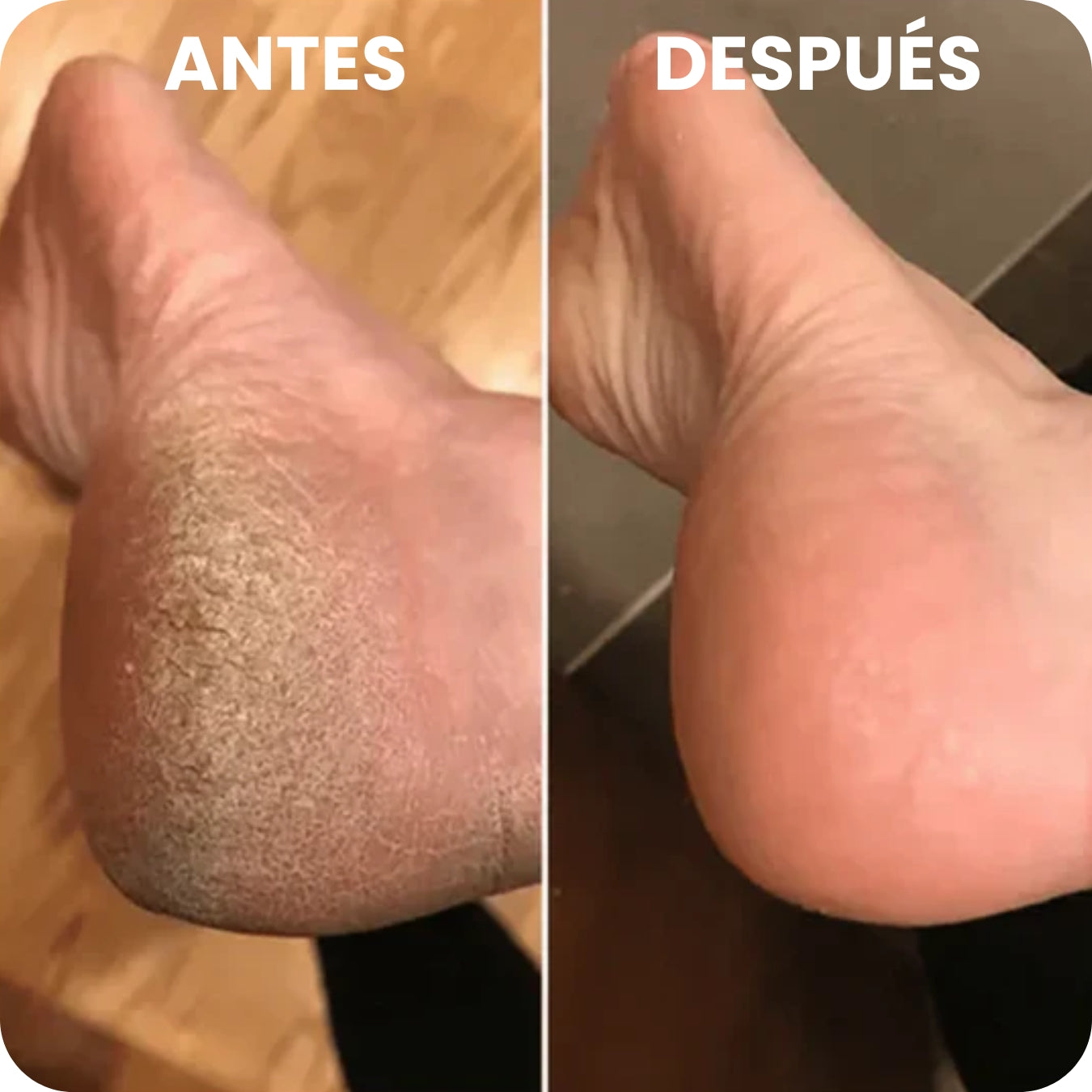 PiesSuaves Pro™🦶 Removedor de Callos Recargable (Edición Limitada)✨