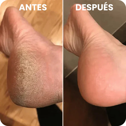 PiesSuaves Pro™🦶 Removedor de Callos Recargable (Edición Limitada)✨
